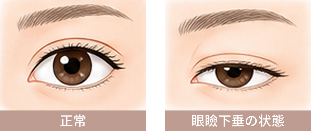 眼瞼下垂症